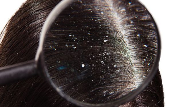 Deretan Penyebab Rambut jadi Ketombe dan Cara Mengatasinya